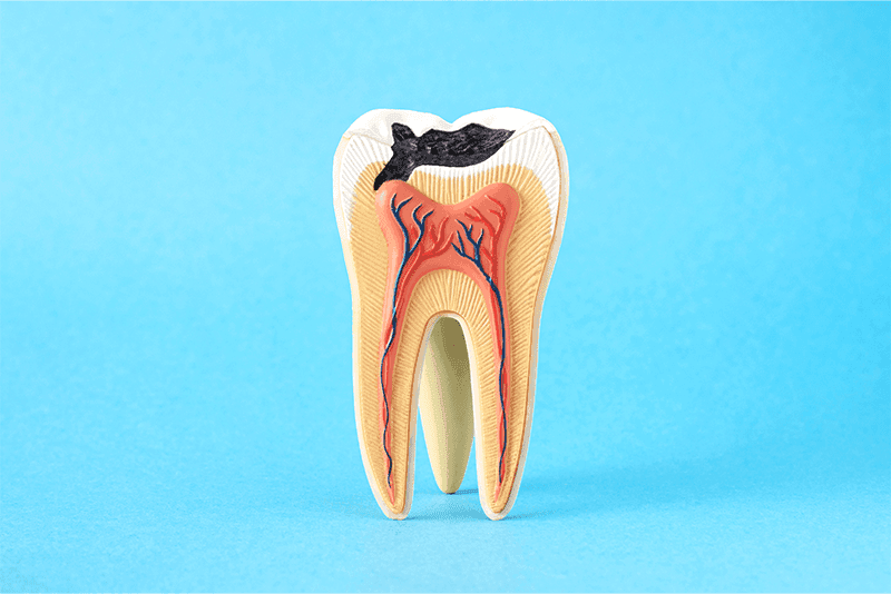 Illustration of tooth decay stages